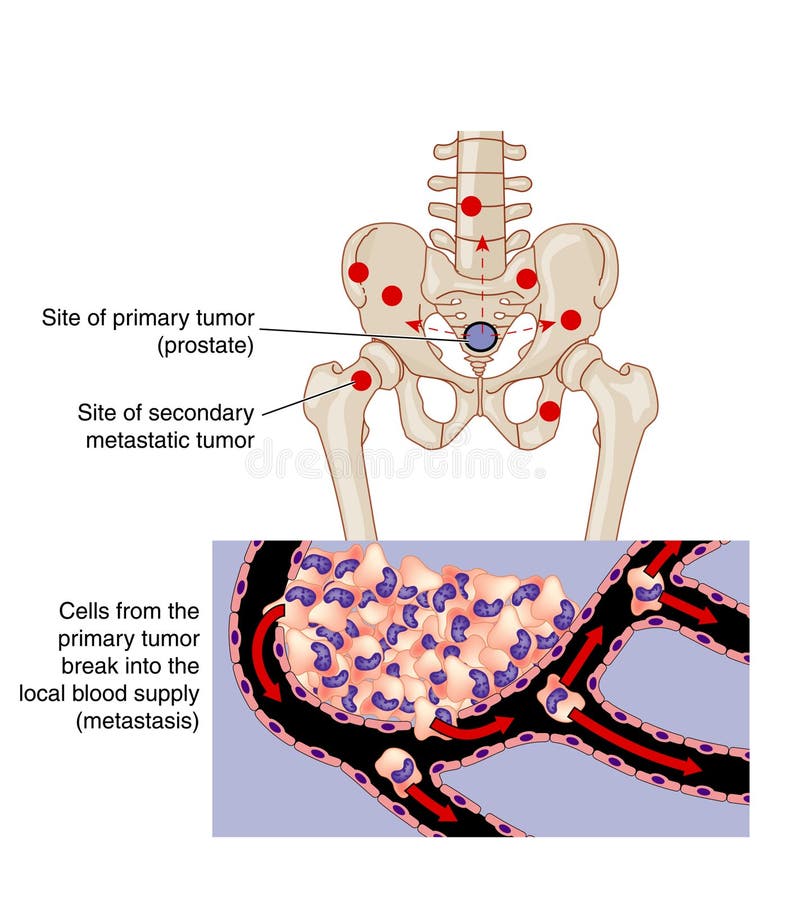 Метастазы в кости при раке предстательной. Метастазирование опухолей. Метастазирование предстательной железы.