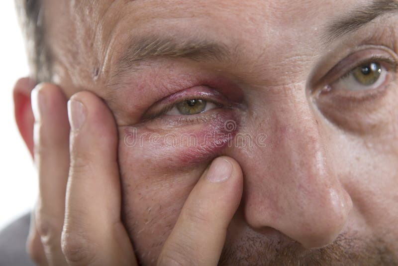 Middle-aged Caucasian Male Emotional Portrait With A Real Bruise Stock ...