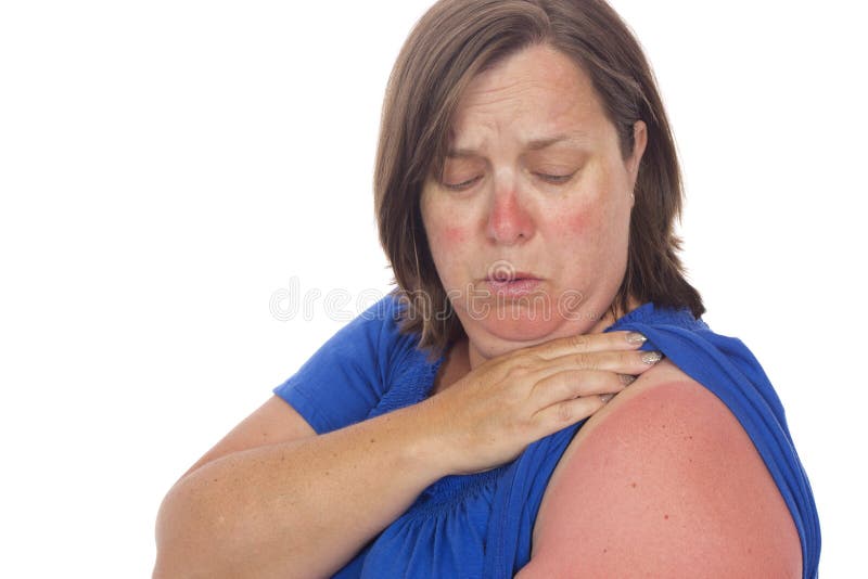 Sun Burn Lines stock photo Sun Burn Lines stock photo