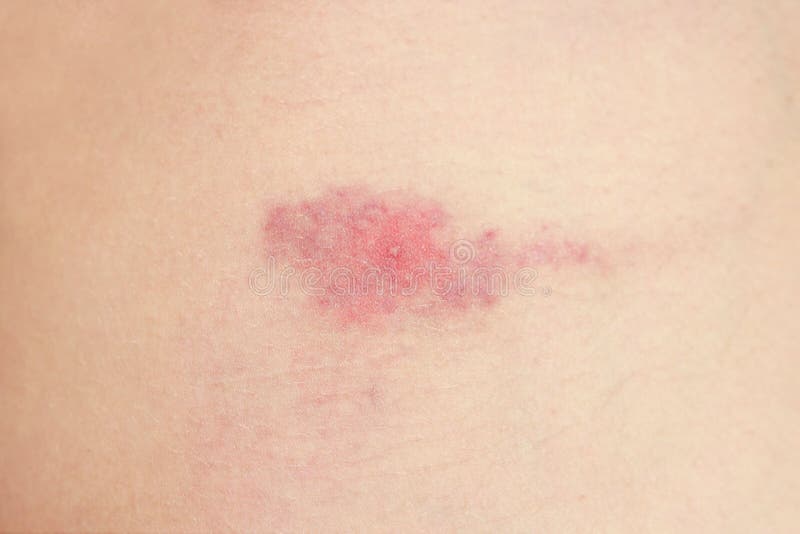 Midge Mosquito Bite Reaction To The Bite Of Midges Allergy Danger Of Insect Bites In The Summer Red Spot At The Bite Site Stock Image Image Of Simuliidotoxicosis Simuliidosis