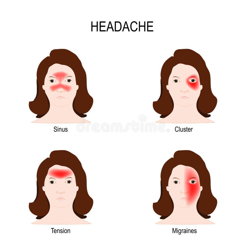 片頭痛と頭痛