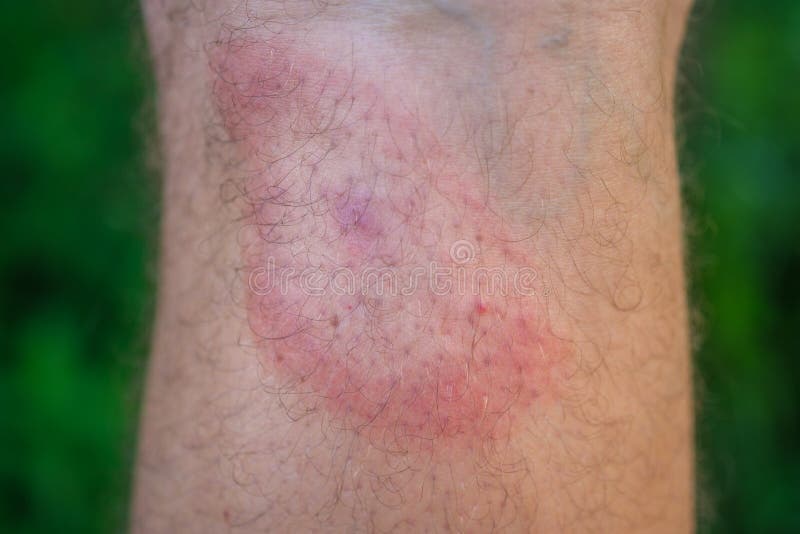 Migrating erythema after a tick bite on a man`s leg.