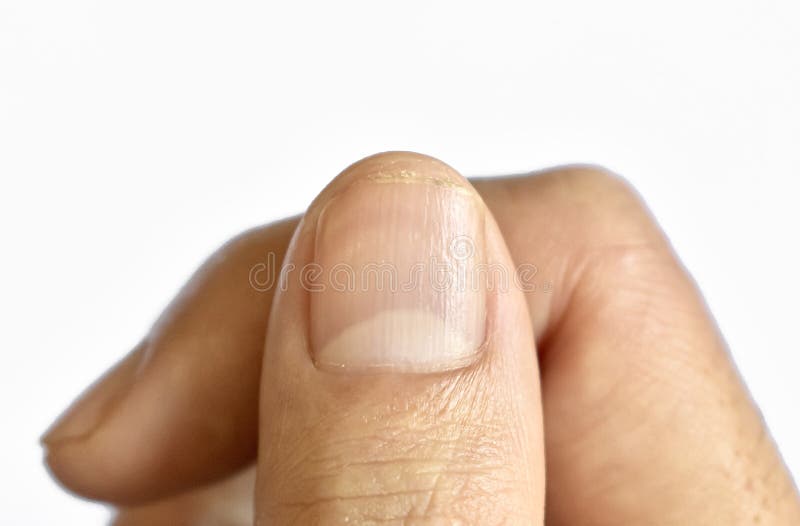 Fingernail pitting due to eczema - Stock Image - C006/9156 - Science Photo  Library
