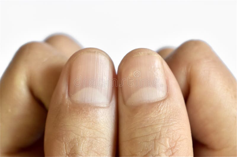 Fingernails Horizontal Lines Stock Photos - Free & Royalty-Free Stock  Photos from Dreamstime