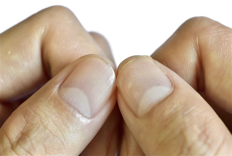 Mild Nail Pitting and Vertical Lines at Thumbs of Southeast Asian, Chinese  Young Man. Stock Photo - Image of nail, moons: 183698210