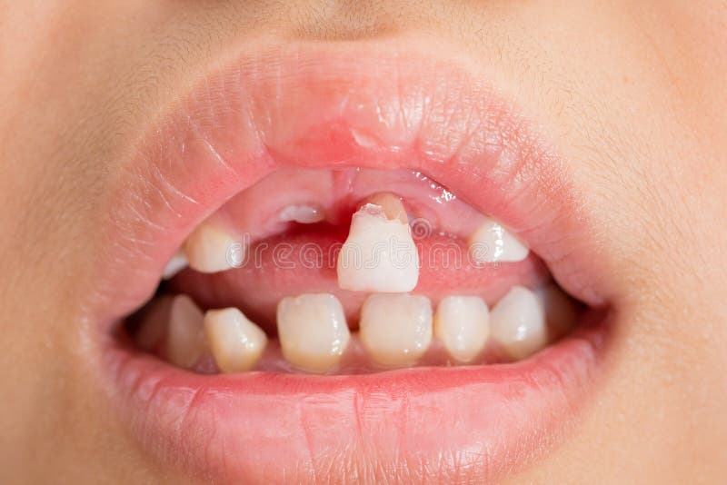 Milk Teeth that are about To Fall Stock Image - Image of dentist, human