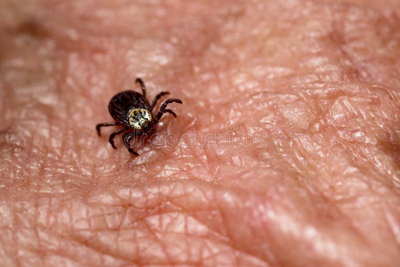 Mite Encephalitis on Human Skin 2019 Stock Image Image of carrier