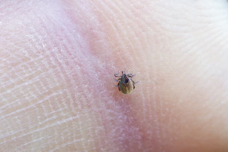 Mite on a skin stock photo. Image of acarid, crawling 54538760