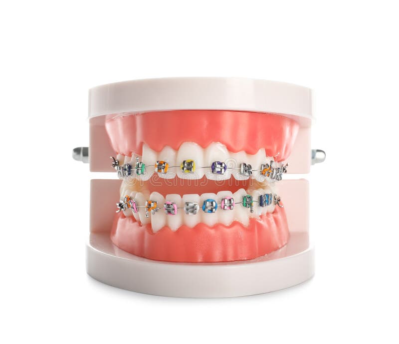 Model of Jaw with Braces Isolated on White Background Stock Photo