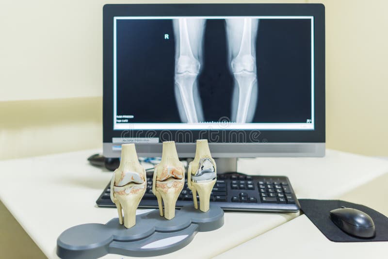 Model of Knee Joint Shows Osteoarthritis of Knee and Total Knee Prosthesis Replacement Surgery