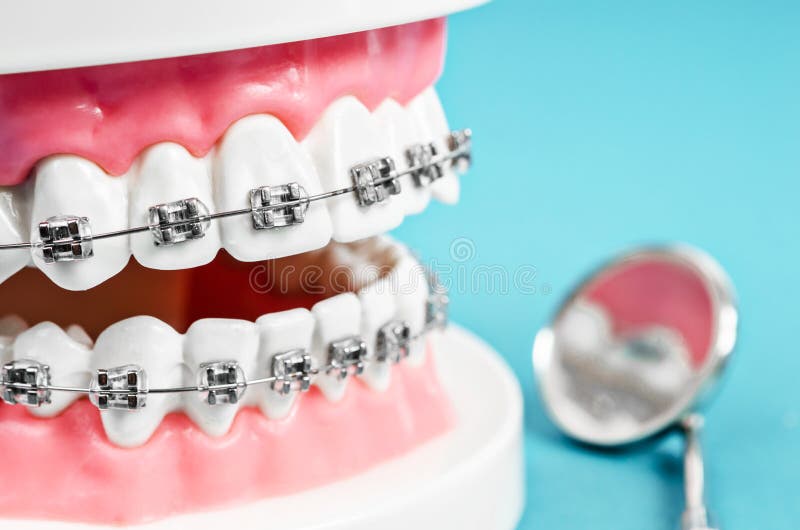 Modello alto vicino del dente con i ganci dentari del nastro metallico fotografie stock libere da diritti Modello alto vicino del dente con i ganci dentari del nastro metallico fotografie stock libere da diritti