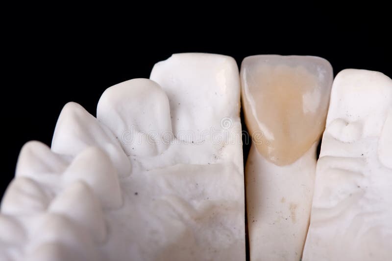 Modello dentale della cera del particolare fotografia stock libera da diritti Modello dentale della cera del particolare fotografia stock libera da diritti