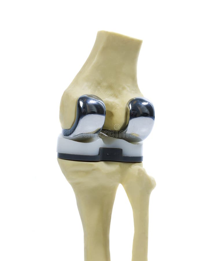 Modello di plastica di un rimontaggio del ginocchio