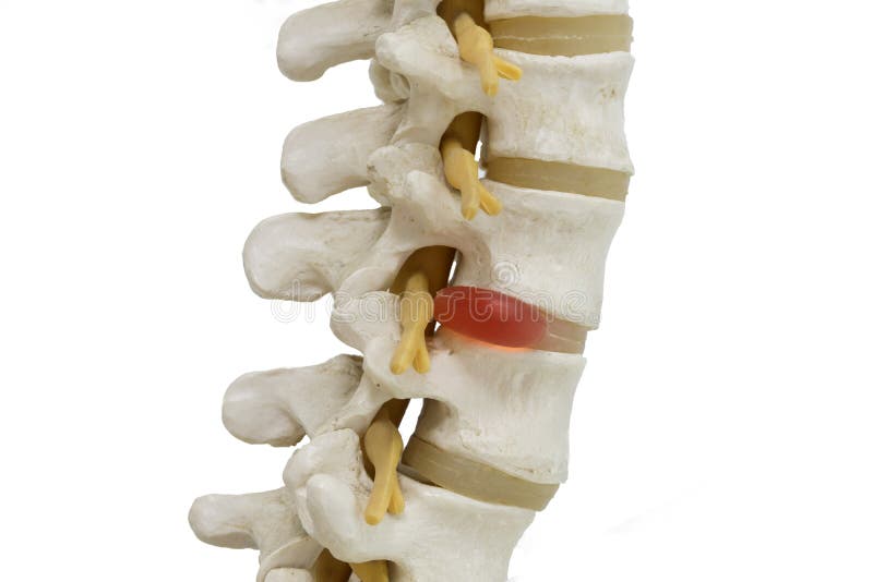 Human lumbar spine model demonstrating herniated disc pressure to nerve root , pressure causing back pain. Human lumbar spine model demonstrating herniated disc pressure to nerve root , pressure causing back pain