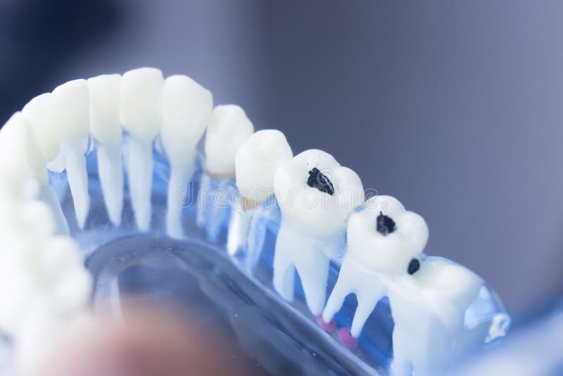 Modelo dental da chapa da deterioração de dentes imagem de stock Modelo dental da chapa da deterioração de dentes imagem de stock