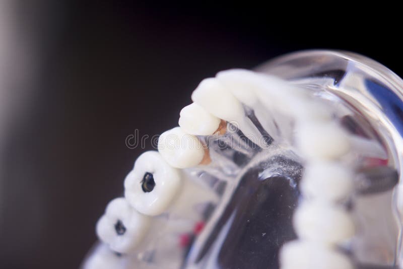 Dentists tooth plastic model with decay used for teaching, learning and patients in dental office showing teeth and gums. Dentists tooth plastic model with decay used for teaching, learning and patients in dental office showing teeth and gums.