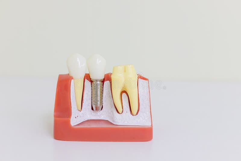 Modelo do implante dental Implante humano do dente Conceito dental Dentes ou dentaduras humanas Ponte do reparo do apoio do dente foto de stock Modelo do implante dental Implante humano do dente Conceito dental Dentes ou dentaduras humanas Ponte do reparo do apoio do dente foto de stock