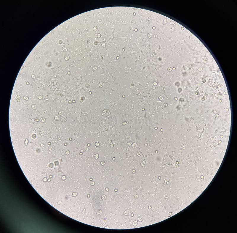 Moderate Bacteria and White Blood Cells in Urine Stock Image Image of