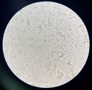 Moderate Bacteria And White Blood Cells In Urine Stock Image Image Of 