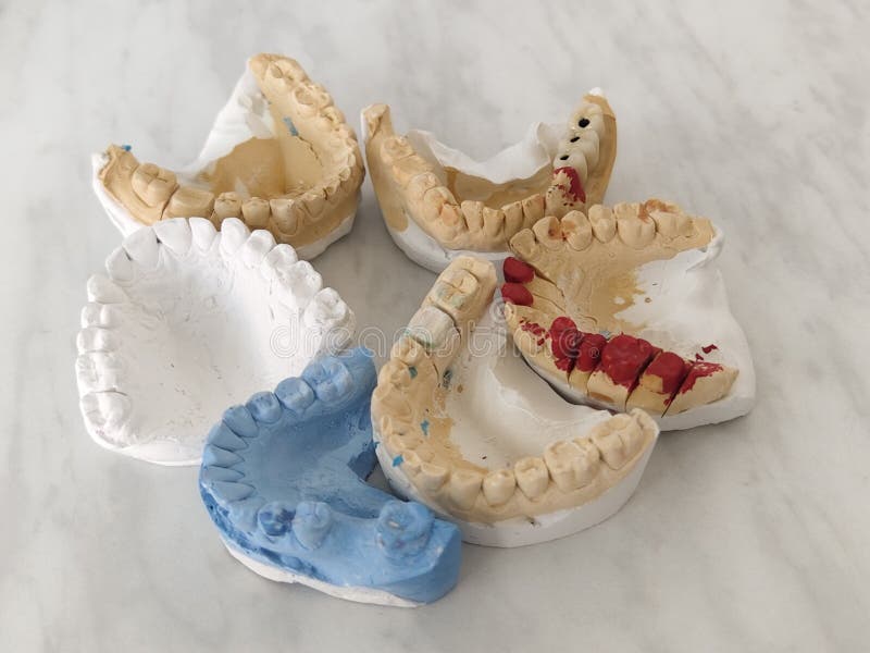 Modern Ceramicmetal Dental Bridge for Restoring Dentition Stock Image