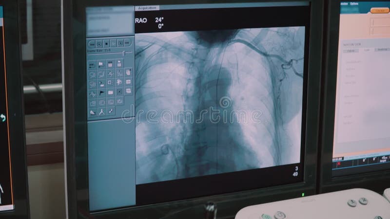 Modern medical pre-operation room in which doctors look into monitors with biometric data about the patient during the operation