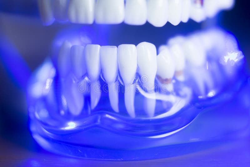 Modèle dentaire de dents d'alignement. Modèle orthodontique de teachng d'art dentaire de dents dentaires avec les gommes, l'émail des dents, la plaque, les racines et les implants en métal