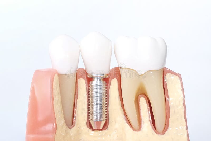 Modèle dentaire générique de dents photo stock Modèle dentaire générique de dents photo stock