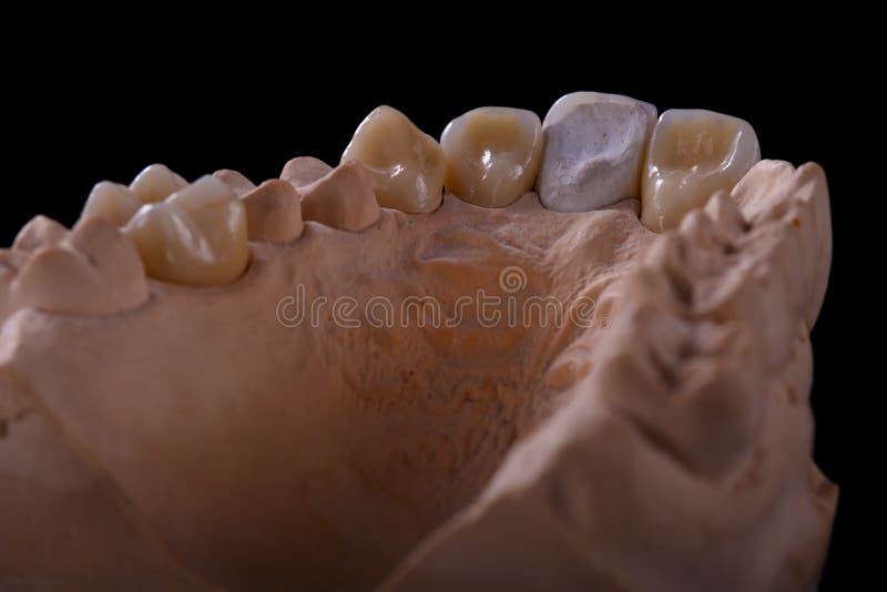 Mold of teeth. Gypsum model plaster of teeth. Stomatologic plaster cast,  molds of human jaws and teeth on gray background. Dentistry and  orthodontics concept Stock Photo