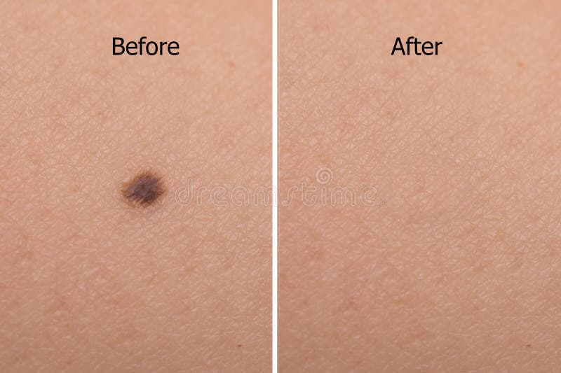 Mole on woman skin before after laser treatment