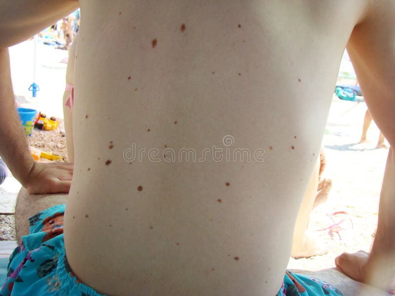 Moles Stock Images Download 1,517 Royalty Free Photos