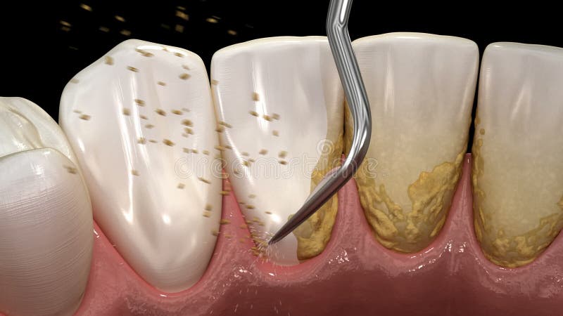 Mondhygiëne : ultrasone tanden schoonmaakmachine voor meetkunde en plaque. medisch nauwkeurige 3d-illustratie