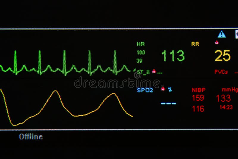 Monitor de EKG en unidad de ICU imagenes de archivo Monitor de EKG en unidad de ICU imagenes de archivo