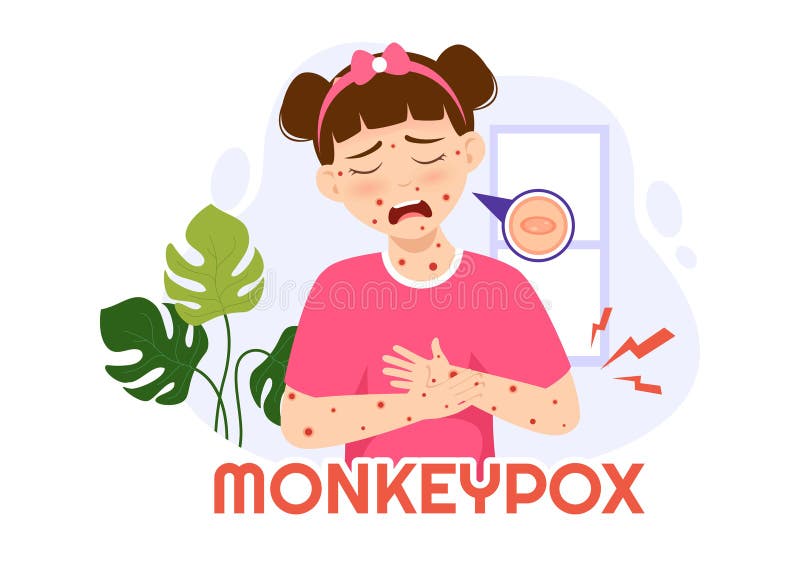 Monkey Pox Outbreak Vector Illustration of Virus Symptoms in Humans
