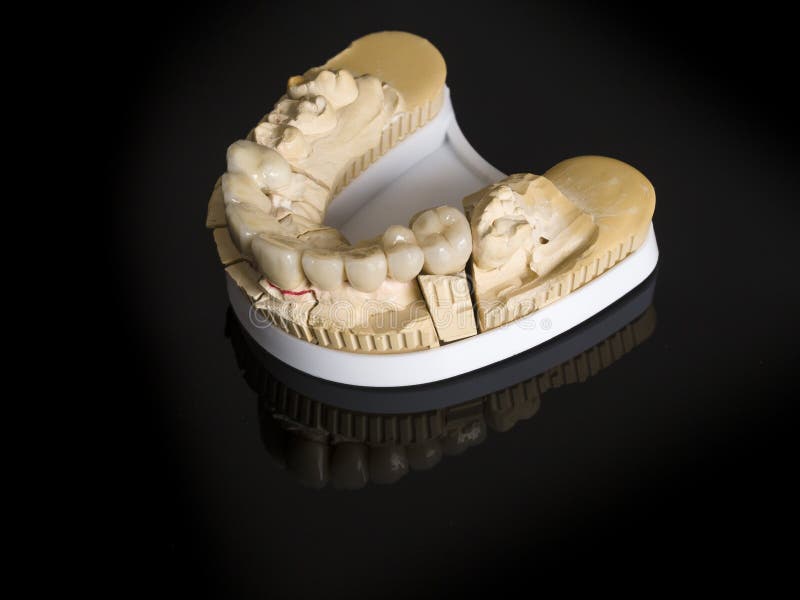 Monolithic Zirconia Restorations Implant Supported with the Cer Stock