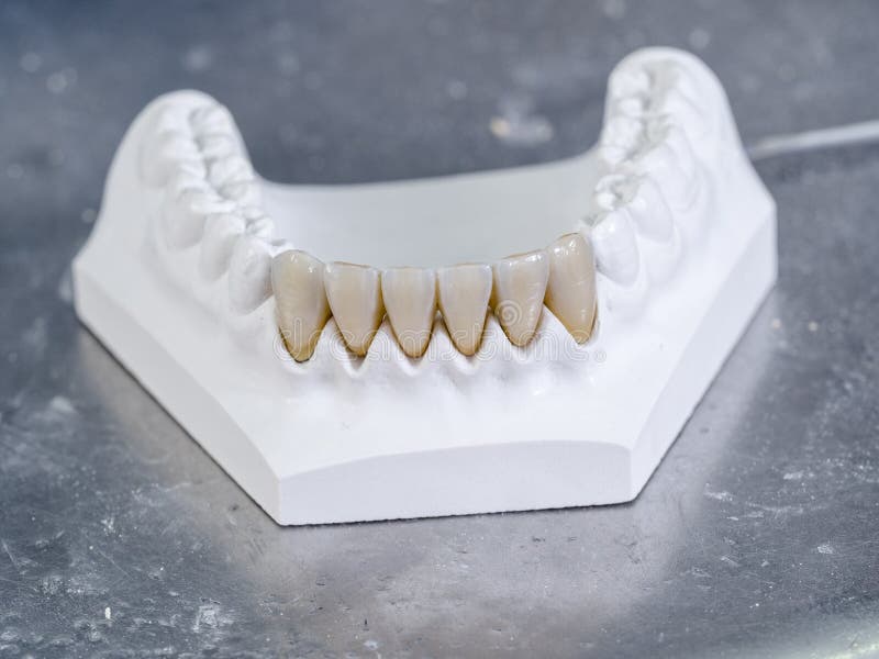 Monolithic Zirconia Restorations. Teeth in a White Cast. Stock Photo