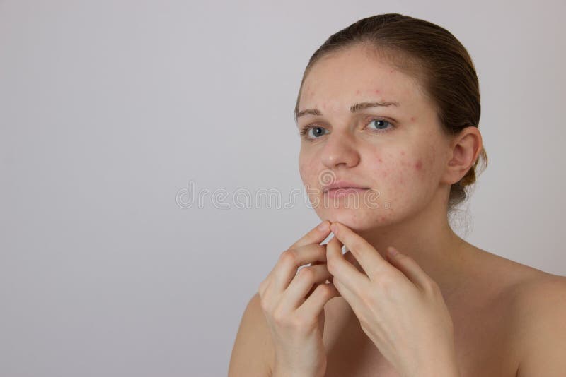 Mooi jong meisje met acne op zijn gezicht en de rug op een whi stock foto Mooi jong meisje met acne op zijn gezicht en de rug op een whi stock foto