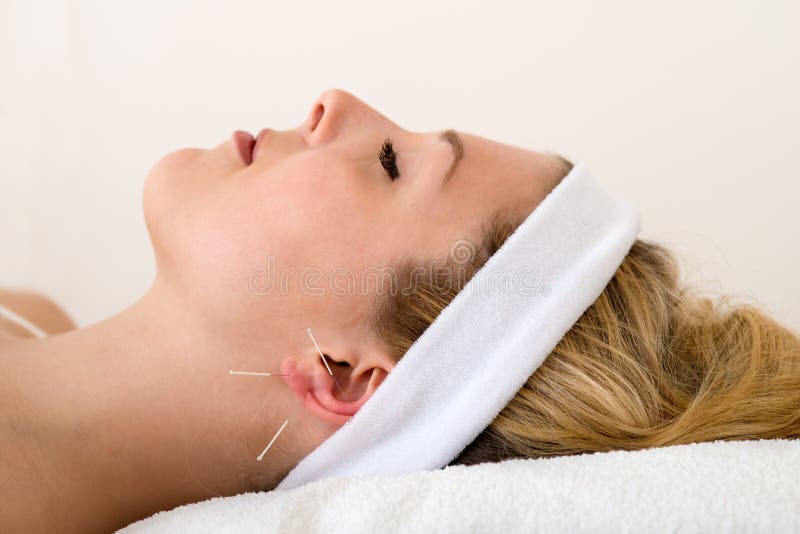 Mooie vrouw die acupunctuur hebben. royalty-vrije stock foto Mooie vrouw die acupunctuur hebben. royalty-vrije stock foto