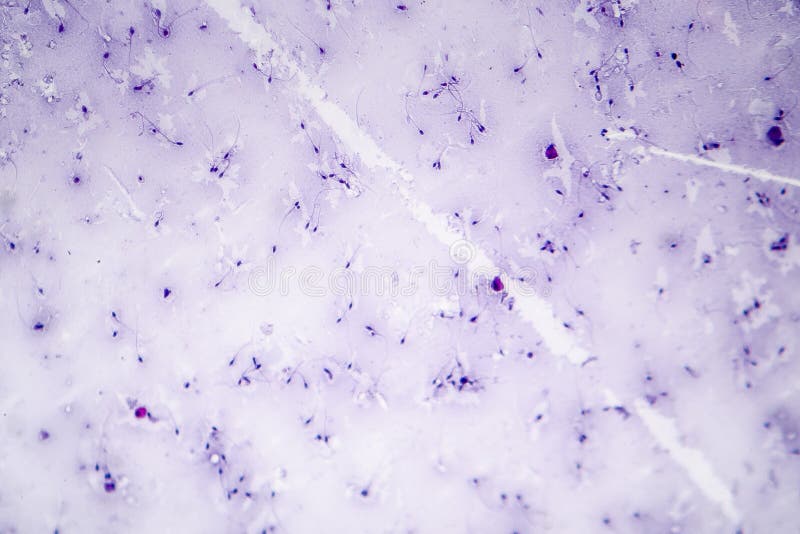 Morfologia do esperma Foto do sêmen sob o microscópio foto de stock Morfologia do esperma Foto do sêmen sob o microscópio foto de stock