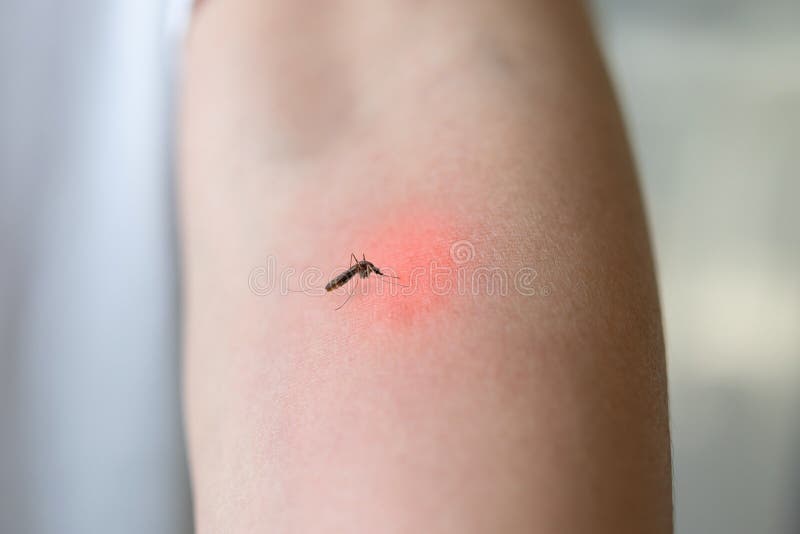 Mosquitoes Bite On Adult Hand Made Skin Rash And Allergy Stock Image