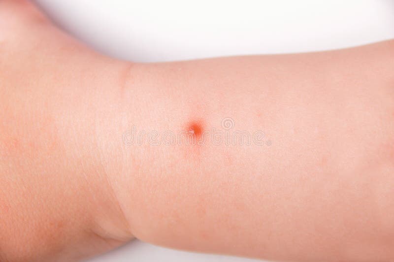 Mosquito Bite Stock Photo Image Of Mosquitoes Pain 126522452