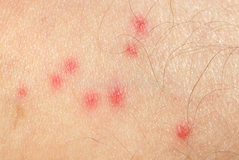 Mosquito Allergy on Human Skin Stock Photo Image of reaction, ingection 19410618