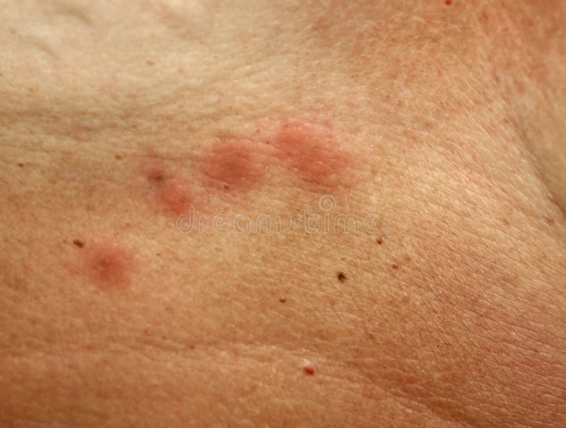 Mosquito Bites on the Skin Under the Breast Stock Image - Image of