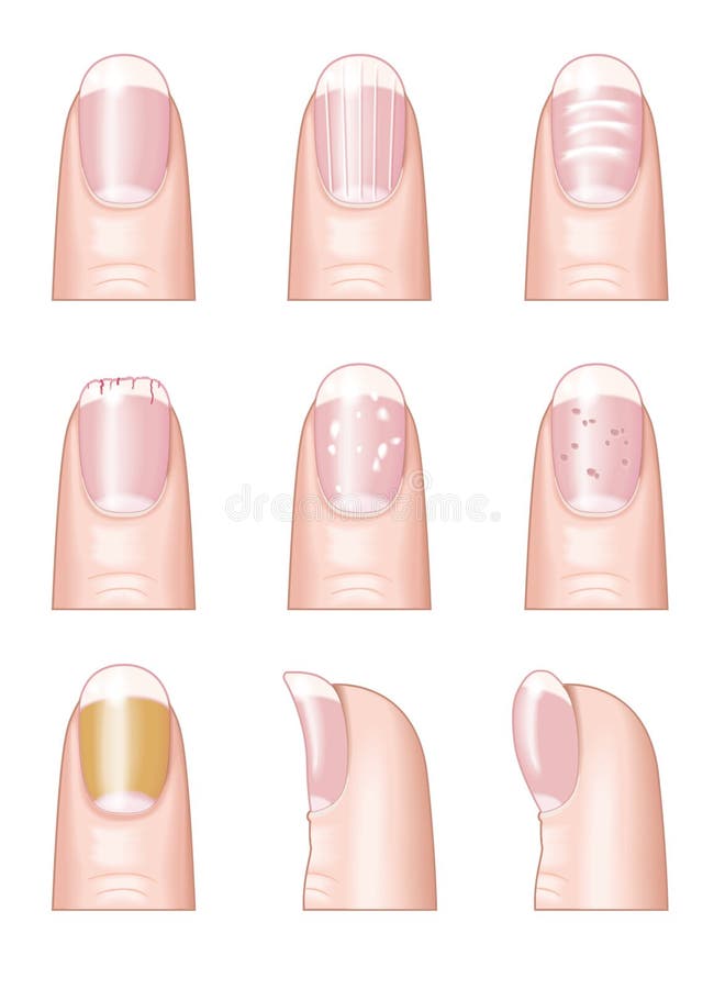 dr.ryanholmes - FUNGAL NAIL INFECTIONS 💅🏼 Fungal nail infections (also  known as onychomycosis) are very common and account for almost 50% of nail  diseases! Infection can result in thickening, crumbling and discolouration