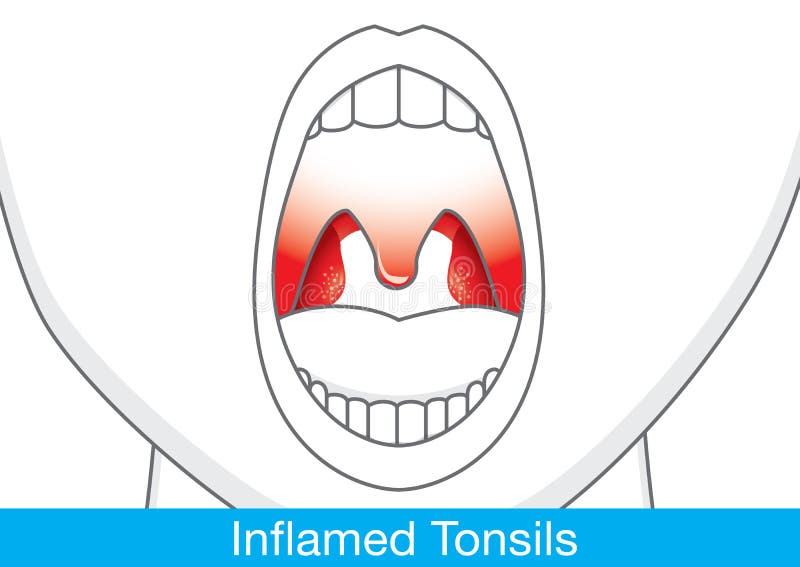 Showing Inflamed tonsils by open mouth. This illustration about health and medical. Showing Inflamed tonsils by open mouth. This illustration about health and medical.