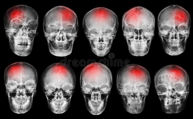 movimiento accidente cerebrovascular Sistema del cráneo de la radiografía de la película imágenes de archivo libres de regalías movimiento accidente cerebrovascular Sistema del cráneo de la radiografía de la película imágenes de archivo libres de regalías