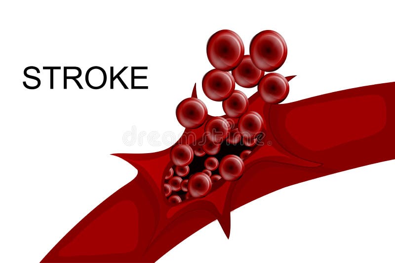 Illustration of a rupture of the vessel. hemorrhagic stroke. insult. Illustration of a rupture of the vessel. hemorrhagic stroke. insult