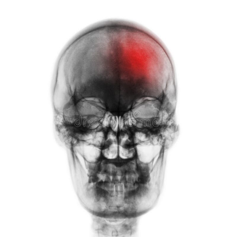 Movimiento y x28; Accidente cerebrovascular y x29; Filme el cráneo de la radiografía del ser humano con área roja Front View foto de archivo Movimiento y x28; Accidente cerebrovascular y x29; Filme el cráneo de la radiografía del ser humano con área roja Front View foto de archivo