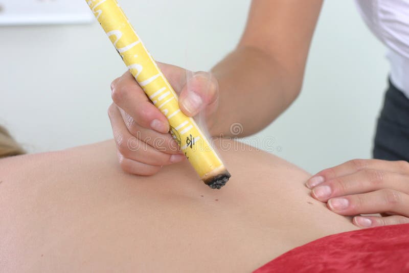 Moxibustion fotografía de archivo Moxibustion fotografía de archivo