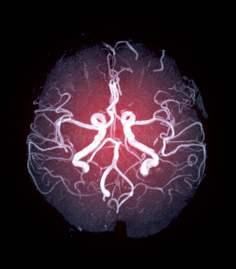 MRA Brain eller magnetresonansangiografi i hjärnan arkivfoto MRA Brain eller magnetresonansangiografi i hjärnan arkivfoto