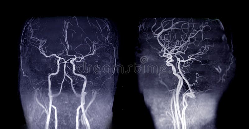 MRA Brain or Magnetic resonance angiography  MRA   of cerebral artery and common carotid artery AP and Lateral View .